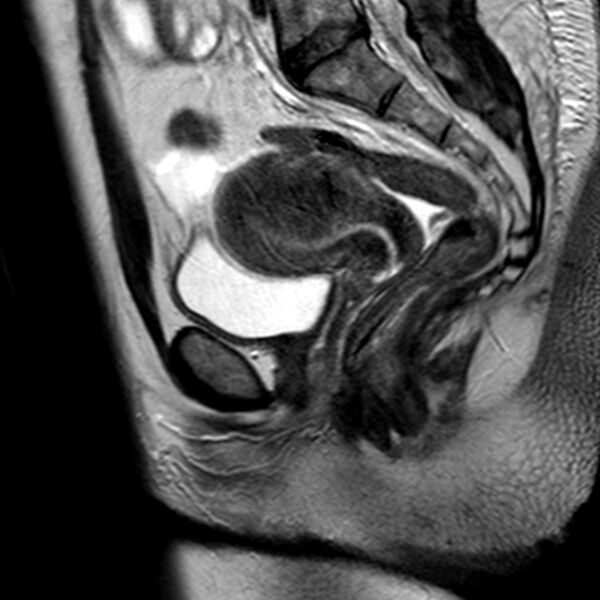 File:Adenomyoma of the uterus (Radiopaedia 9871-10439 Sagittal T2 13).jpg