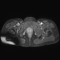 Adenomyoma of the uterus (huge) (Radiopaedia 9870-10438 Axial T1 C+ fat sat 4).jpg