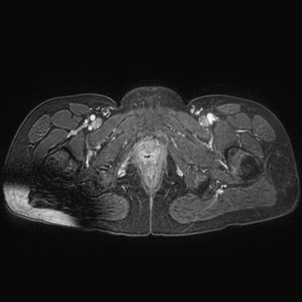 File:Adenomyoma of the uterus (huge) (Radiopaedia 9870-10438 Axial T1 C+ fat sat 4).jpg