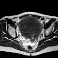 Adenomyoma of the uterus (huge) (Radiopaedia 9870-10438 Axial T2 19).jpg