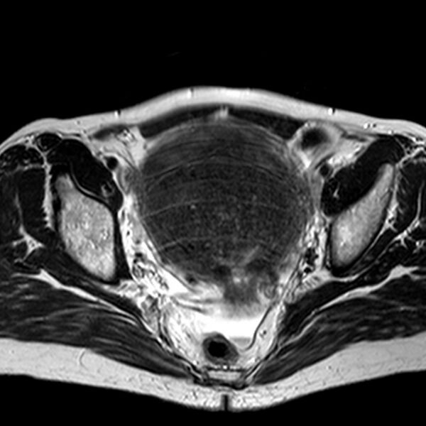 File:Adenomyoma of the uterus (huge) (Radiopaedia 9870-10438 Axial T2 19).jpg