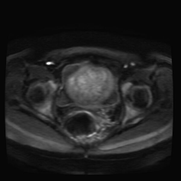 File:Adenomyosis on MRI (Radiopaedia 29328-29780 Axial DWI 10).jpg
