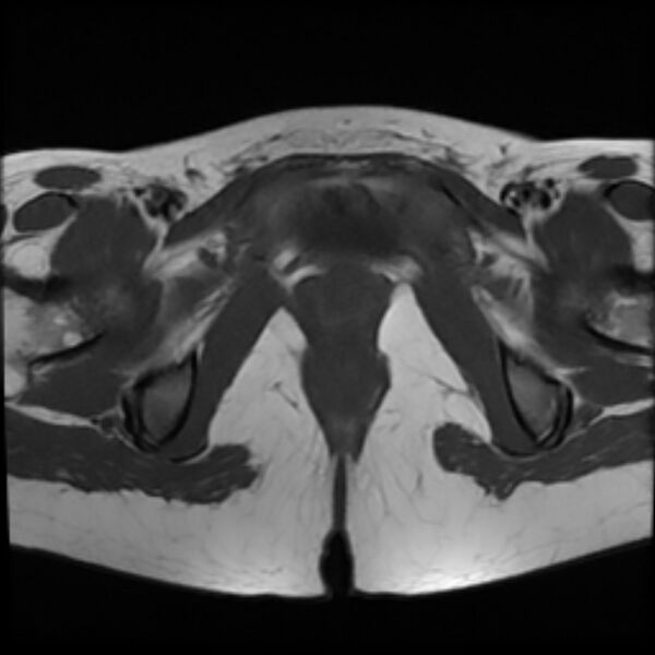 File:Adenomyosis within a septate uterus (Radiopaedia 69963-79981 Axial T1 25).jpg