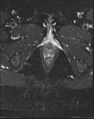 Adnexal multilocular cyst (O-RADS US 3- O-RADS MRI 3) (Radiopaedia 87426-103754 Axial T2 fat sat 26).jpg