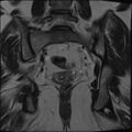 Adnexal multilocular cyst (O-RADS US 3- O-RADS MRI 3) (Radiopaedia 87426-103754 Coronal T2 23).jpg