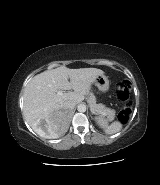 File:Adrenal cortical carcinoma with IVC invasion and thrombosis (Radiopaedia 34307-35597 Axial C+ portal venous phase 21).jpg