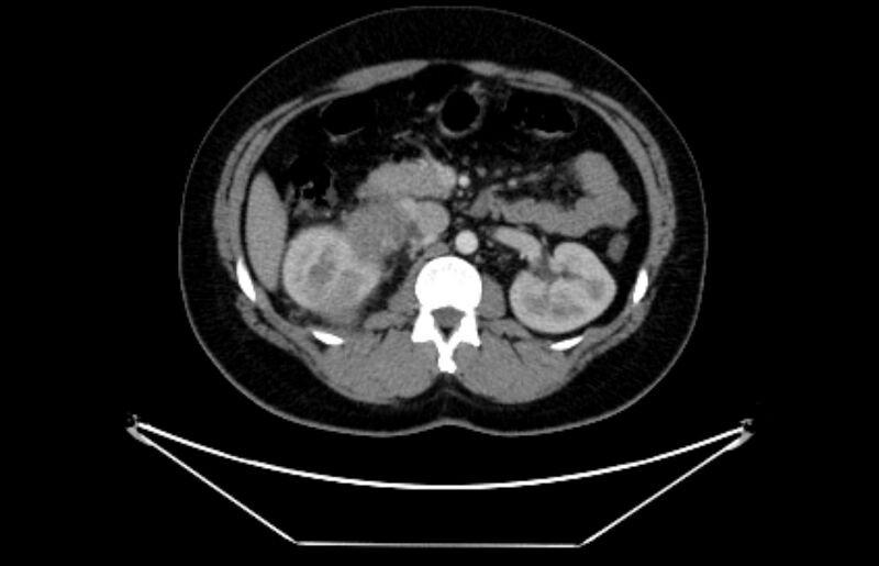 File:Adrenocortical carcinoma (Radiopaedia 80134-93438 Axial C+ portal venous phase 55).jpg