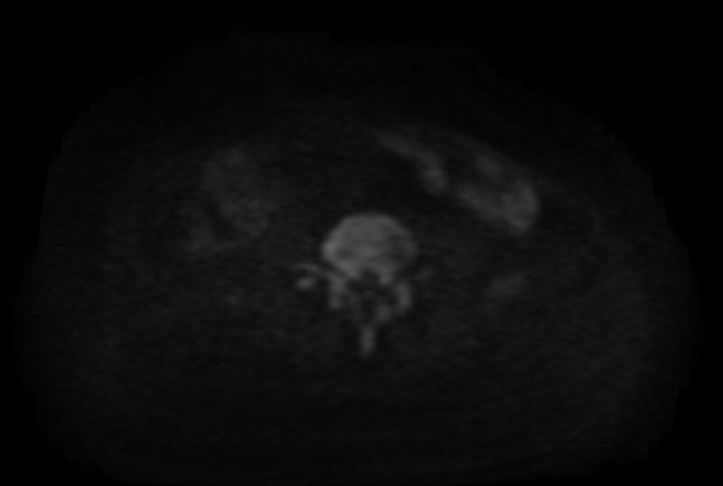 File:Adult granulosa cell tumor of the ovary (Radiopaedia 71581-81950 Axial DWI 1).jpg