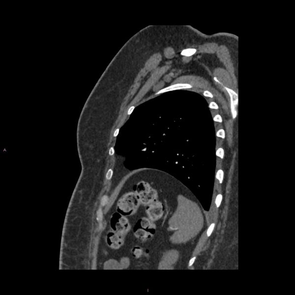 File:Agenesis of the left hepatic lobe (Radiopaedia 77284-89359 Sagittal C+ CTPA 91).jpg
