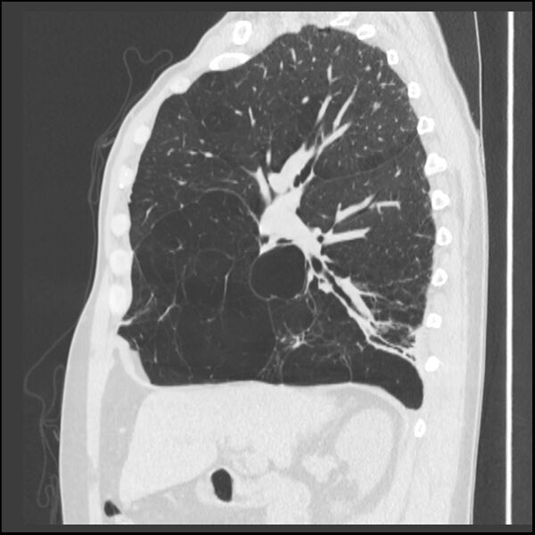 File:Alpha-1-antitrypsin deficiency (Radiopaedia 40993-43722 Sagittal lung window 170).jpg