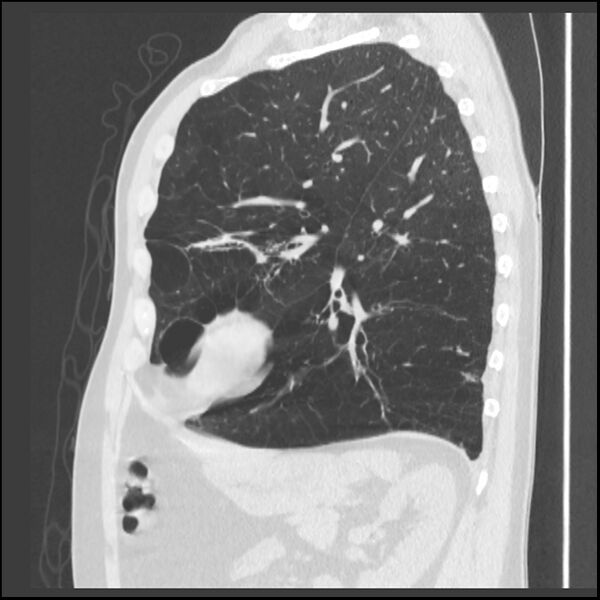 File:Alpha-1-antitrypsin deficiency (Radiopaedia 40993-43722 Sagittal lung window 85).jpg