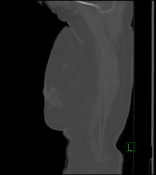 File:Amiodarone deposition in the liver (Radiopaedia 77587-89780 Sagittal bone window 95).jpg