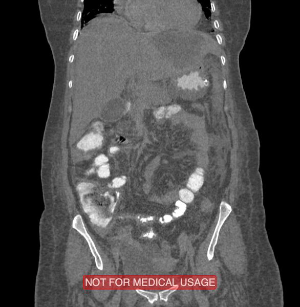 File:Amoebic enterocolitis with liver abscess (Radiopaedia 35100-36609 B 73).jpg