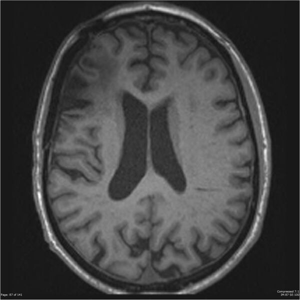 File:Anaplastic meningioma with recurrence (Radiopaedia 34452-35788 Axial T1 85).jpg