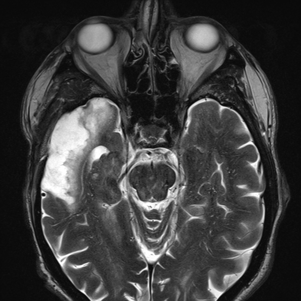 File:Anaplastic meningioma with recurrence (Radiopaedia 34452-35788 Axial T2 6).png
