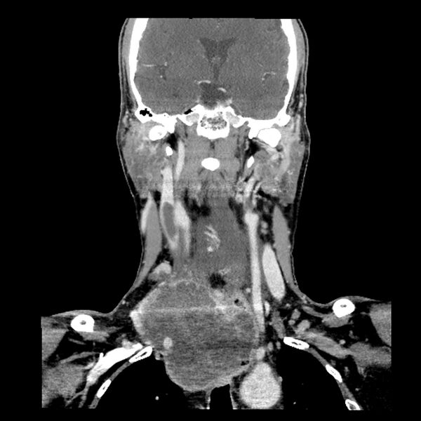 File:Anaplastic thyroid carcinoma (Radiopaedia 79087-92034 A 66).jpg
