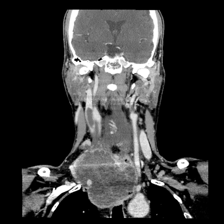 Anaplastic thyroid carcinoma (Radiopaedia 79087-92034 A 66).jpg