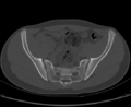 Aneurysmal bone cyst of ischium (Radiopaedia 25957-26094 Axial bone window 29).png
