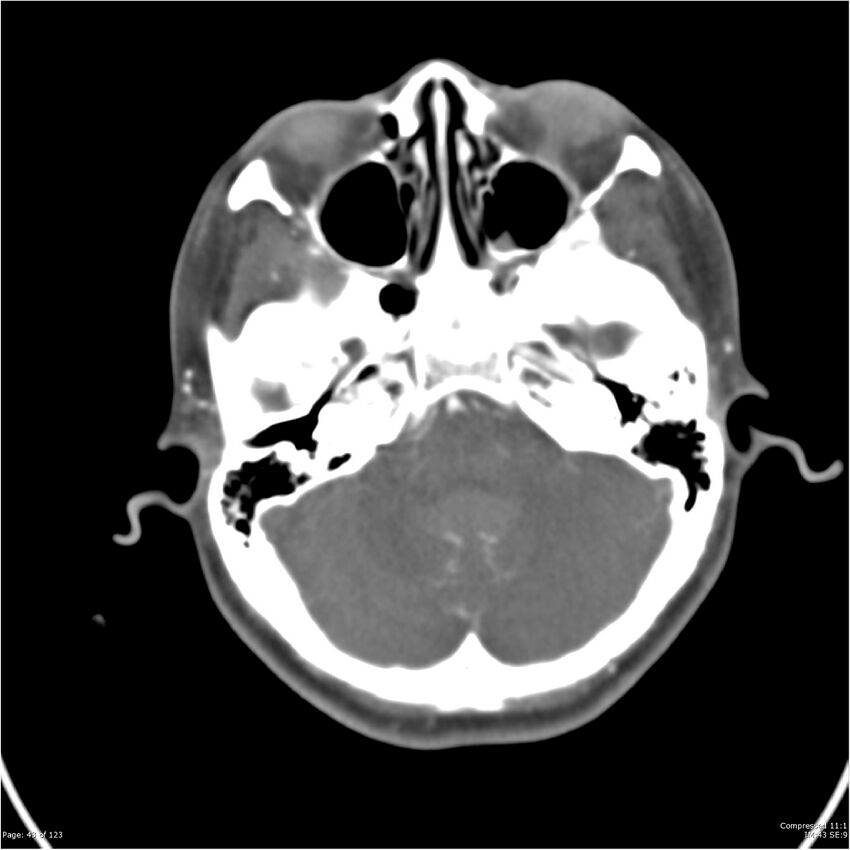 Aneurysmal subarachnoid hemorrhage and Moya Moya disease (Radiopaedia 34306-35593 Axial CT COW 43).jpg