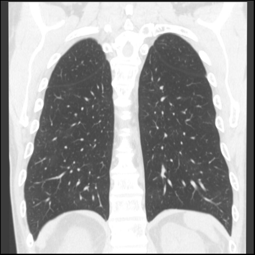Angioinvasive aspergillosis (Radiopaedia 43957-47466 Coronal lung window 24).jpg