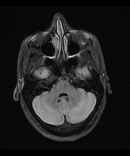 File:Angiomatous meningioma (Radiopaedia 79459-92579 Axial T2 TIRM 6).jpg