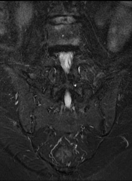 File:Ankylosing spondylitis - Andersson lesion (Radiopaedia 81878-95838 Coronal STIR 9).jpg