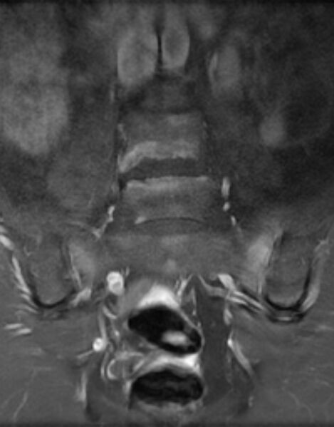 File:Ankylosing spondylitis - Andersson lesion (Radiopaedia 81878-95838 H 5).jpg