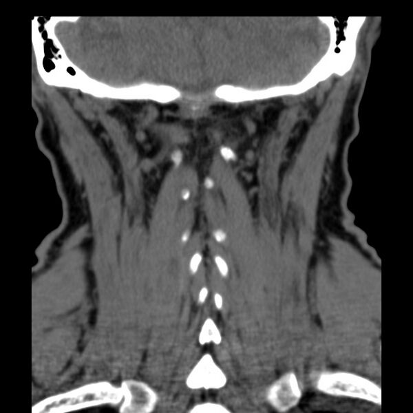 File:Anterior cervical postdiscectomy arthrodesis (Radiopaedia 32678-33646 Coronal non-contrast 30).jpg