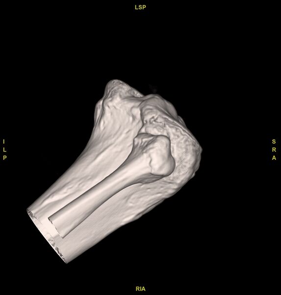File:Anterior cruciate ligament avulsion fracture (Radiopaedia 58939-66194 VRT 8).jpg