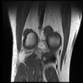 Anterior cruciate ligament tear with posteromedial corner injury, bucket-handle meniscal tear and chondral delamination (Radiopaedia 75501-86744 Coronal T1 21).jpg