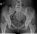 Anterior superior iliac spine avulsion fracture (Radiopaedia 68390).jpg