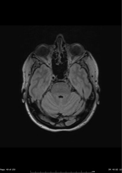 File:Anterior temporal lobe perivascular space (Radiopaedia 40946-43650 Axial FLAIR 1).jpg