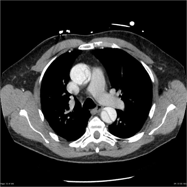 File:Aortic dissection- Stanford A (Radiopaedia 37759-39664 A 23).jpg