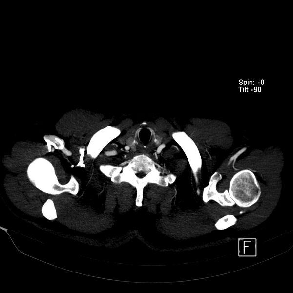File:Aortic dissection - De Bakey type III - Stanford B (Radiopaedia 21903-21882 B 3).jpg