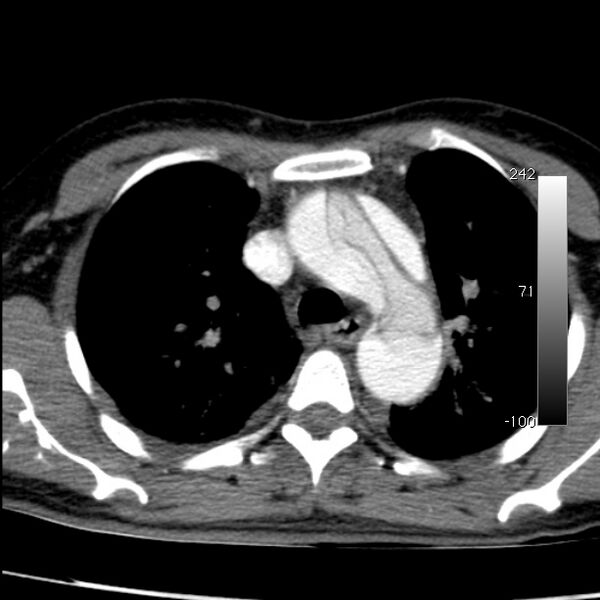File:Aortic dissection - Stanford type A (Radiopaedia 29247-29659 A 24).jpg