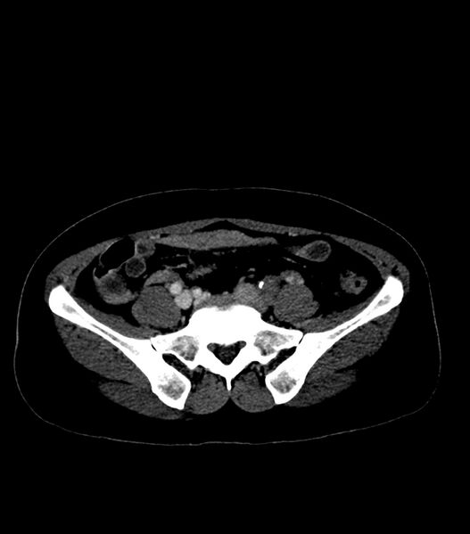 File:Aortic dissection with renal ischemia (Radiopaedia 76573-88338 B 51).jpg