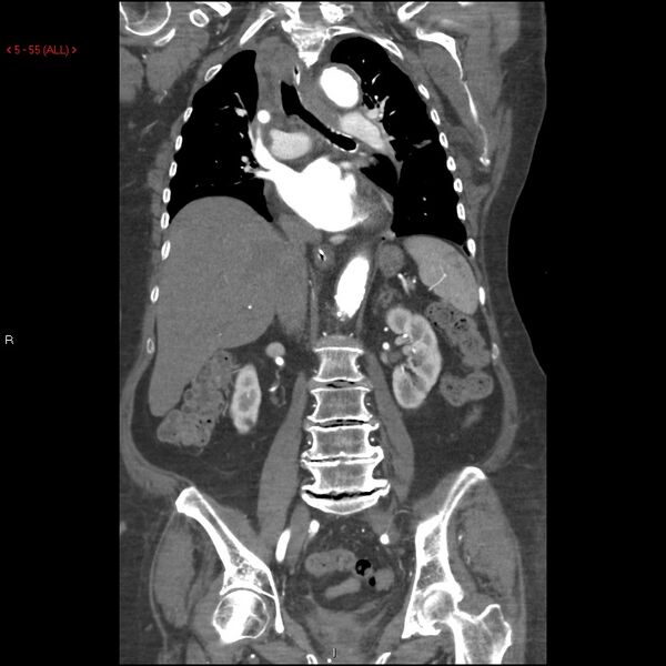 File:Aortic intramural hematoma (Radiopaedia 27746-28001 B 32).jpg