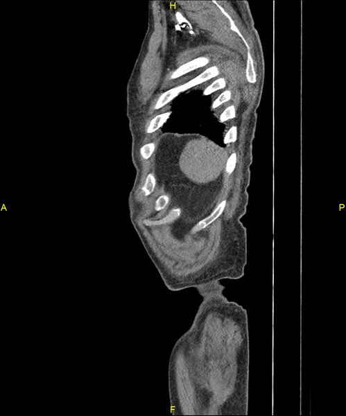 File:Aortoenteric fistula (Radiopaedia 84308-99603 C 315).jpg