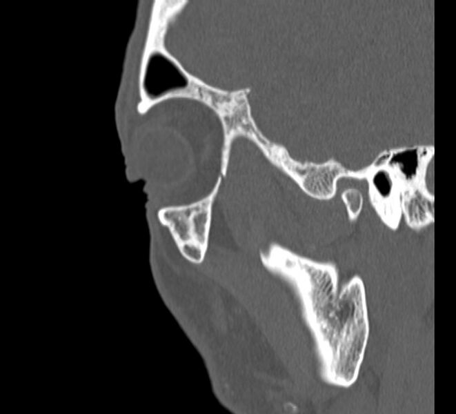 File:Aplastic maxillary sinuses (Radiopaedia 60030-67561 Sagittal bone window 30).jpg