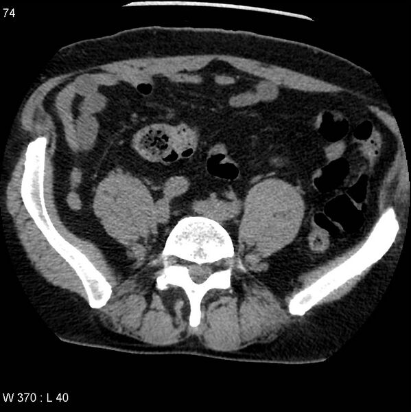File:Appendicitis (Radiopaedia 12510-12733 Axial non-contrast 32).jpg