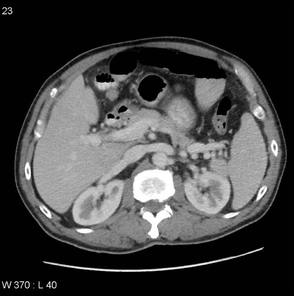 File:Appendicitis (Radiopaedia 27446-27642 A 9).jpg