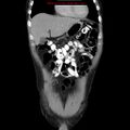 Appendicitis and renal cell carcinoma (Radiopaedia 17063-16760 B 7).jpg
