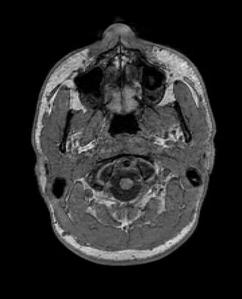 File:Arachnoid cyst- extremely large (Radiopaedia 68741-78451 Axial T1 5).jpg