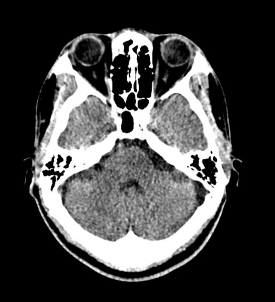 File:Arachnoid cyst of the ambient cistern (Radiopaedia 81301-94986 Axial non-contrast 19).jpg