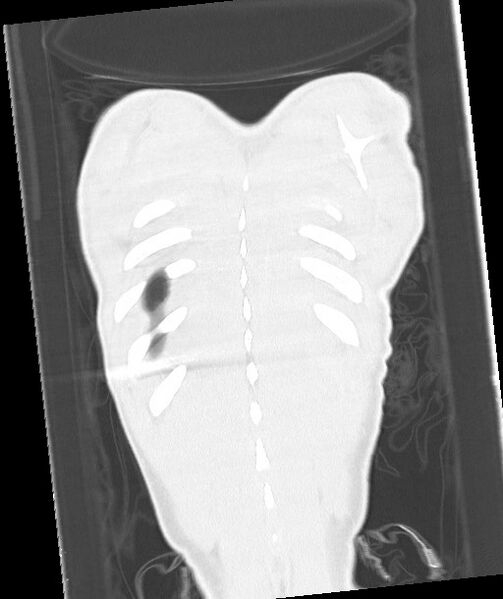 File:Arrow injury to the chest (Radiopaedia 85367-100975 Coronal lung window 118).jpg