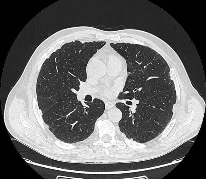 File:Asbestos pleural placques (Radiopaedia 57905-64872 Axial lung window 124).jpg