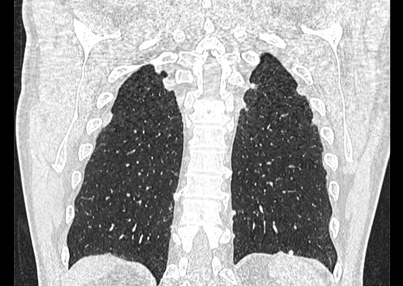 File:Asbestos pleural placques (Radiopaedia 57905-64872 Coronal lung window 240).jpg
