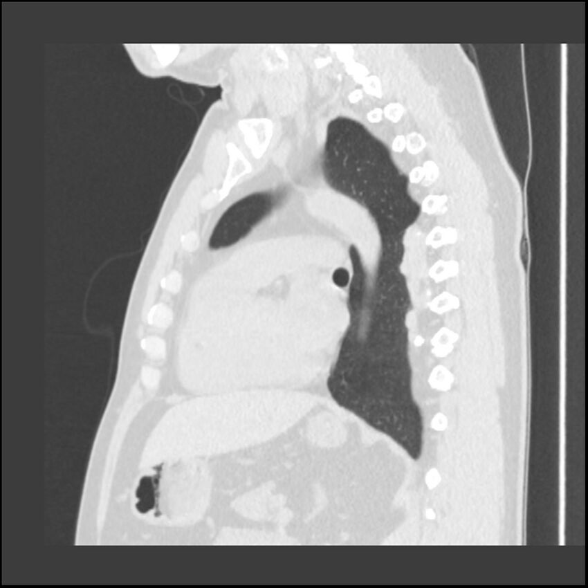 Asbestosis (Radiopaedia 45002-48961 Sagittal lung window 54).jpg