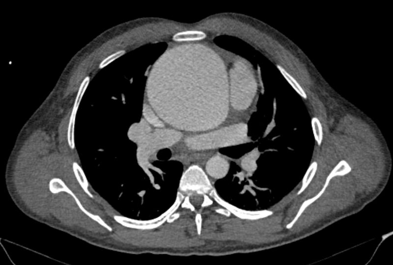 File:Ascending aortic aneurysm (Radiopaedia 86279-102297 C 26).jpg