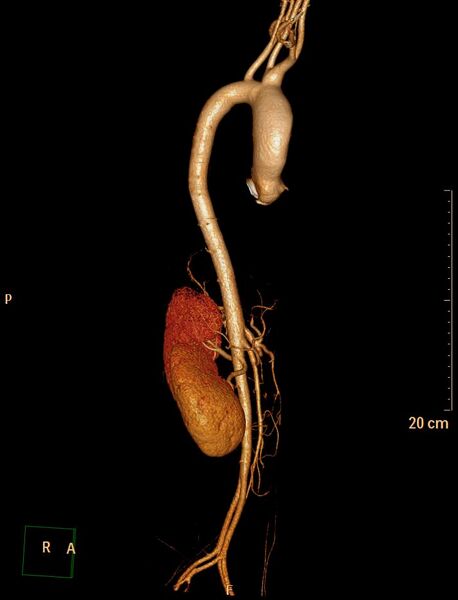 File:Ascending aortic pseudoaneurysm (Radiopaedia 28638-28910 D 8).jpg